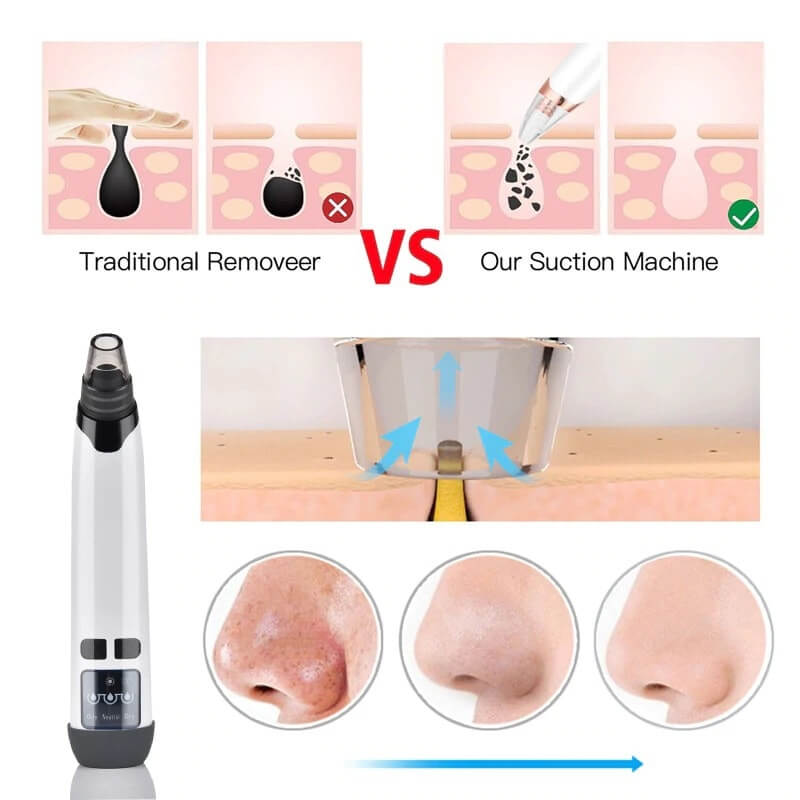 youtiful pore vacuum blackhead remover 2022 edition skin care treatment acne picture 3